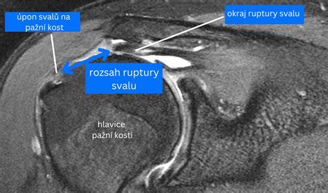 Anatomické zobrazenie svalov rotátorovej manžety
