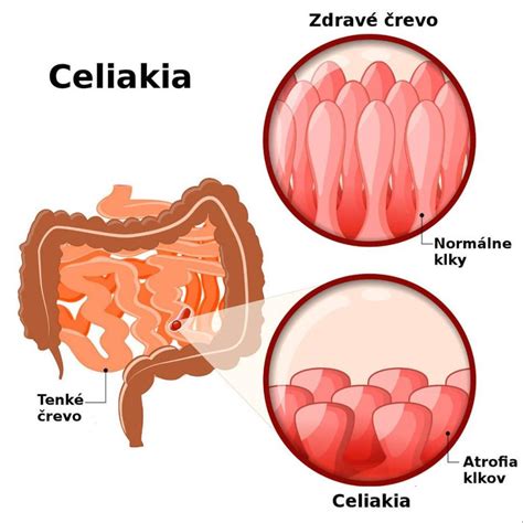 Schematické znázornenie riedenia homeopatických prípravkov