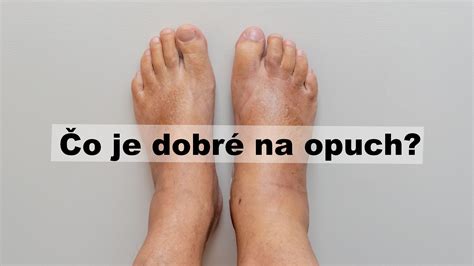 Opuch končatín u zomierajúceho