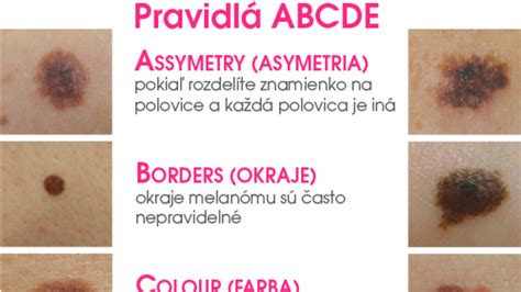 Ilustrácia pravidla ABCDE pre rozpoznanie znamienok