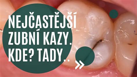 Ilustrácia vypadnutého zuba