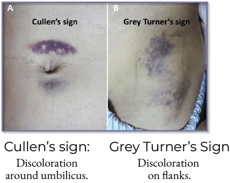 Cullen's sign illustration with periumbilical ecchymosis