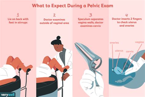 Illustration of bimanual pelvic exam for Hofstatter's sign