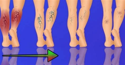 Ilustrácia nohy s kŕčovými žilami a odporúčanými cvičeniami