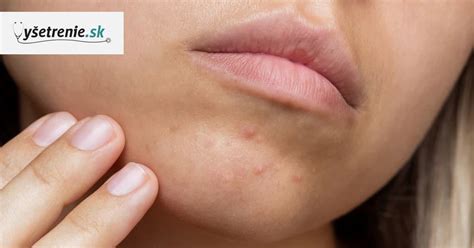 Mačacie akné na brade