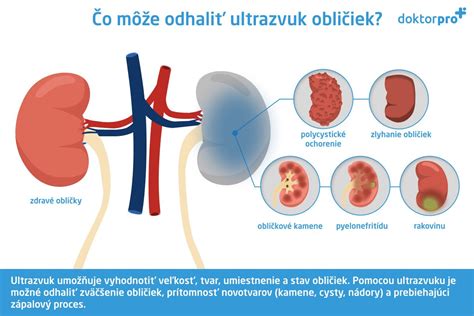 Diagram obličiek a močového systému